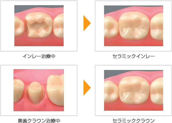 セラミック