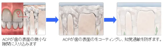 ホーム・ホワイトニング（片顎）・・・13,000円（4週間分のジェルおよびトレー付き）