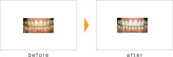 ホワイトニング